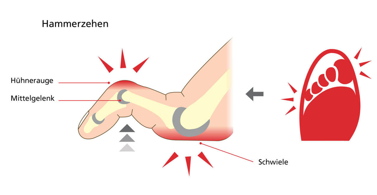 Diagram showing hammer toe with labeled corns and a callus on the middle joint, highlighting pain points.