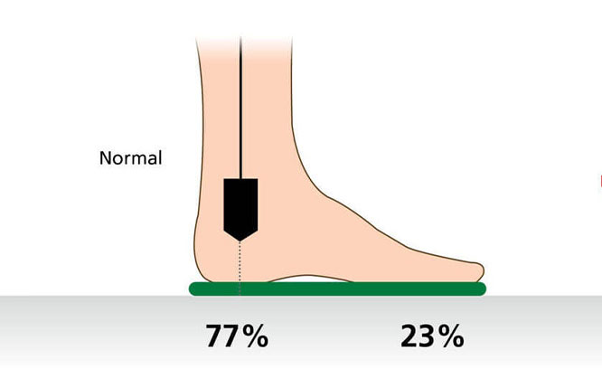 Diagram showing normal foot pressure with 77% on heel and 23% on front