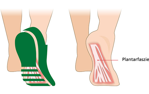 Illustration showing the plantar fascia on a foot and a shoe with supportive design features